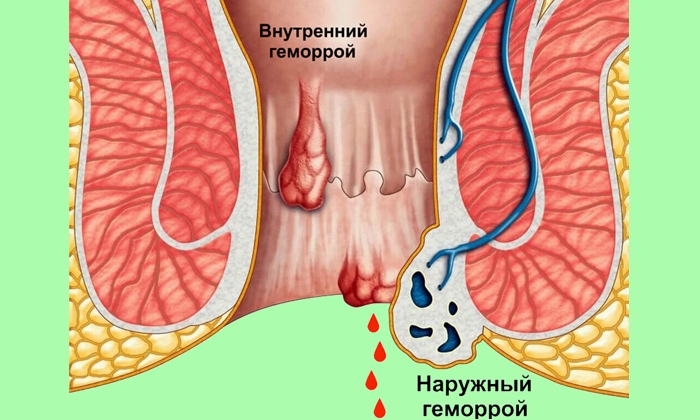 Геморроидальный узел – это сплетение варикозно изменённых сосудистых каналов, находящихся либо в подслизистом слое прямокишечного канала, либо под кожными покровами вокруг ануса