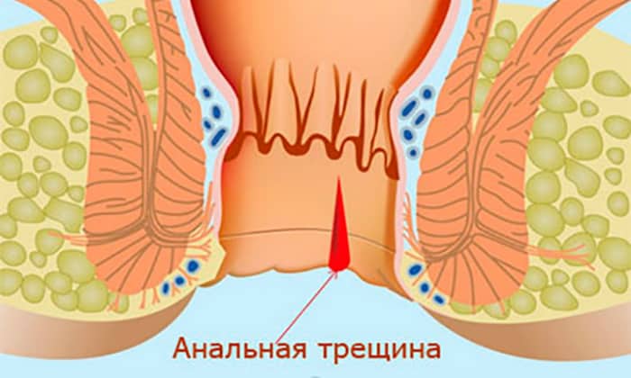 Натальсид назначают в случае возникновения трещинок
