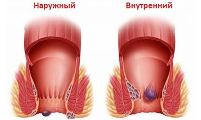 Геморрой – это самая распространенная проктологическая патология, в основе которой лежит варикозное изменение  кавернозных вен прямой кишки и/или анальной области
