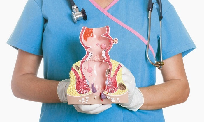 Лечение различных видов геморроя