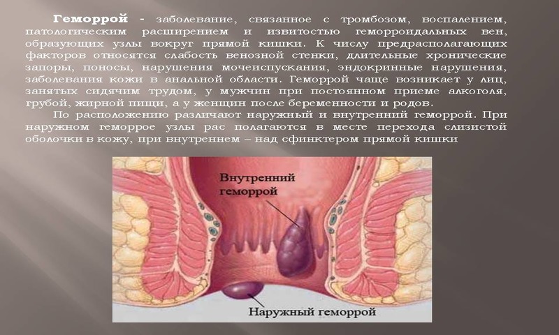 Разрастание геморроидальных узелков – достаточно распространённый патологический процесс, встречающийся у многих жителей современных мегаполисов