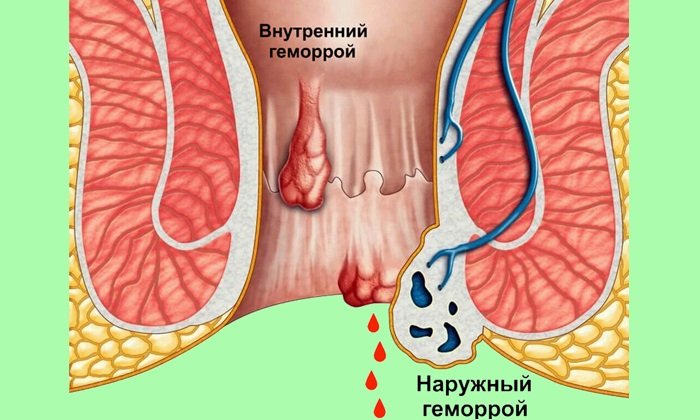 геморрой без боли но с кровью