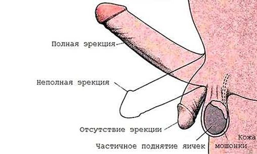 При очаговых и диффузных изменениях предстательной железы может наступить эректильная дисфункция