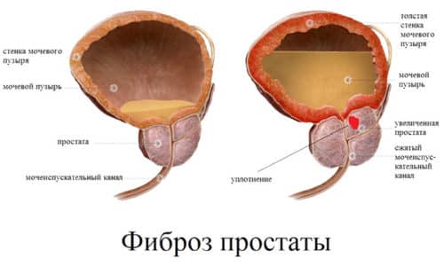 Фиброз - это разрастание грубой соединительной ткани с образованием рубцов