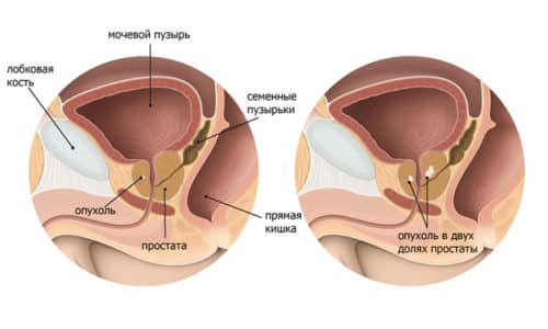 Выделяют фиброз предстательной железы с кистозной трансформацией