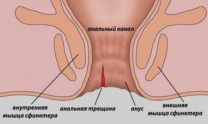 Препарат можно применять для лечения анальных трещин