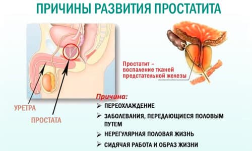 Существует целый ряд причин неинфекционного характера, которые могут спровоцировать простатит