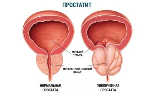 Простатит - опасное воспалительное заболевание предстательной железы