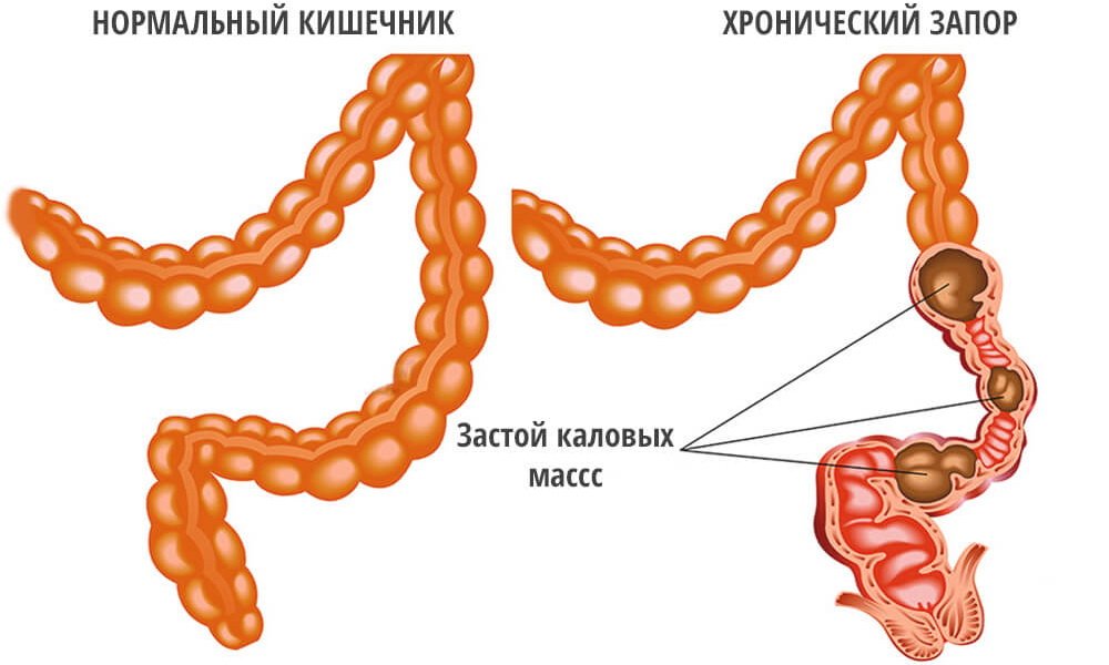 Применение препарата позволяет опорожнить и очистить кишечник больного