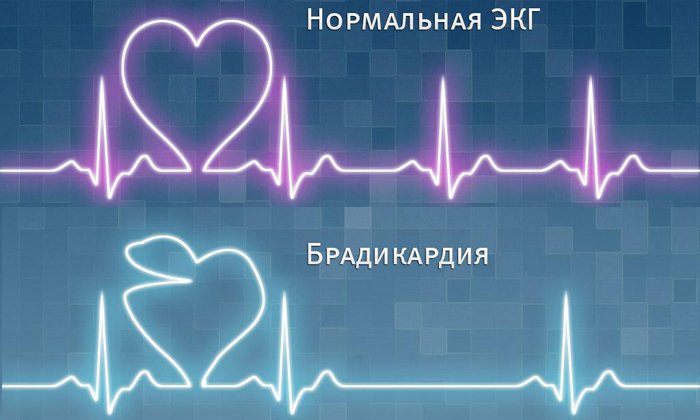 Лекарство не назначается при наличии брадикардии