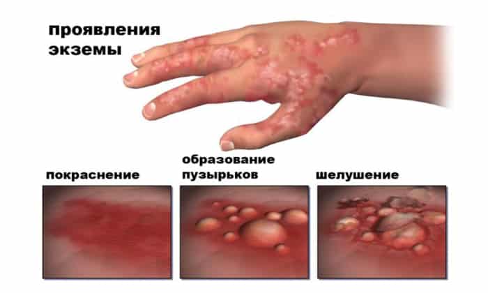 Висмута субгаллат применяется при экземе
