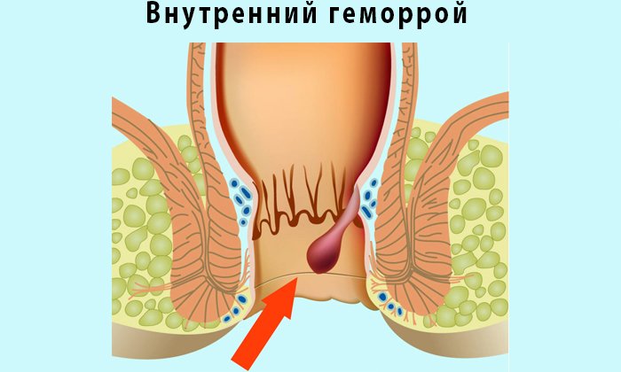 При внутреннем геморрое мазь необходимо вводить в задний проход
