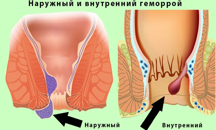 Врачами при геморрое нередко выписывают Изиклин послабляющего действия