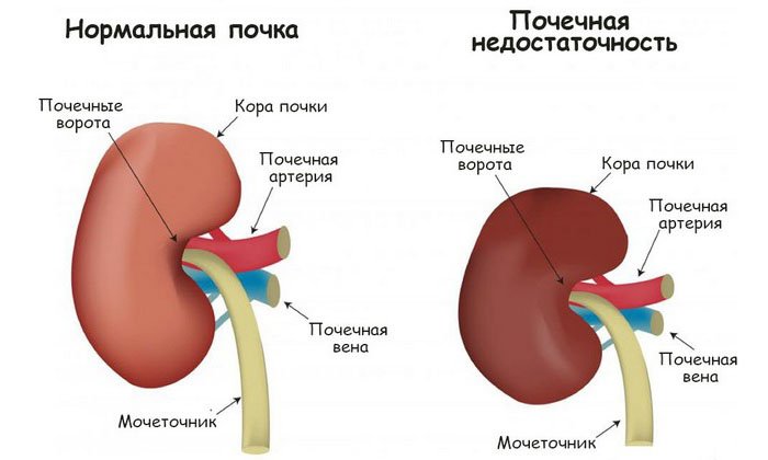 Слабительное не рекомендуется употреблять при тяжелой патологии почек