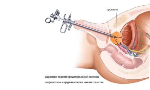 Существуют две минимально инвазивные процедуры, используемые при РПЭ, одна из них с помощью лапароскопического оборудования