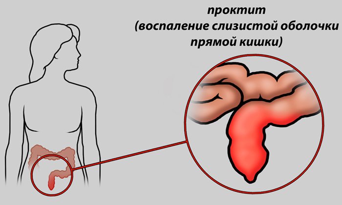 Ректальные суппозитории назначаются при проктите