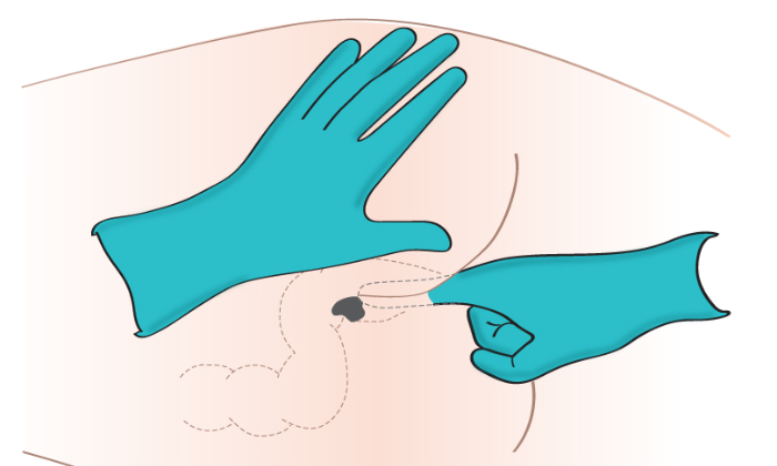При геморрое чаще используются растворы для ректального введения