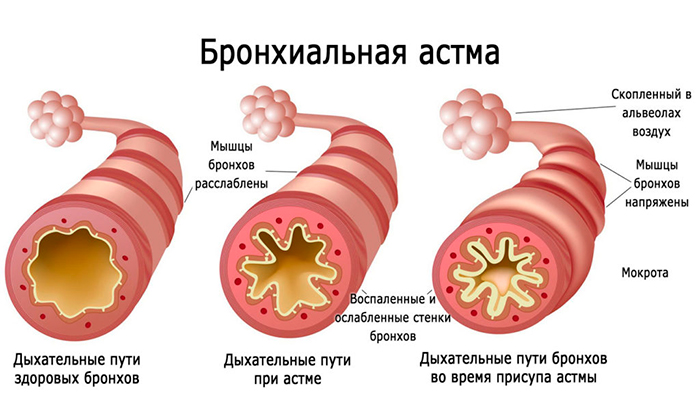Показанием для использования Преднизолона может являться бронхиальная астма