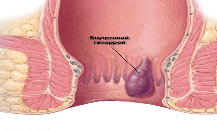 Внутренний геморрой – это гипертрофия венозного сплетения прямой кишки выше её сфинктеров. На 3-4 стадии заболевания геморроидальные шишки выпадают из ректального канала наружу