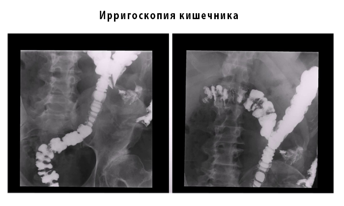 Поскольку ирригоскопия не вызывает боли и нетравматична, наркоз для нее не используют